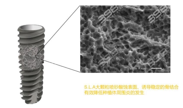 种植牙图片