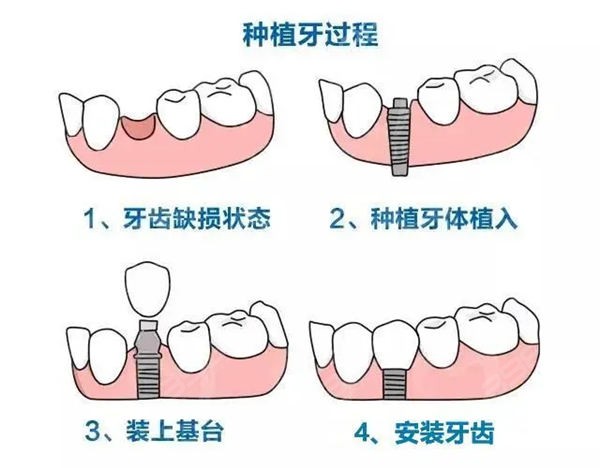 种植牙安装过程