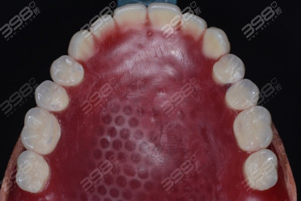 半口牙齿缺失比较传统的治疗方法便是进行活动义齿的修复,有多种技术