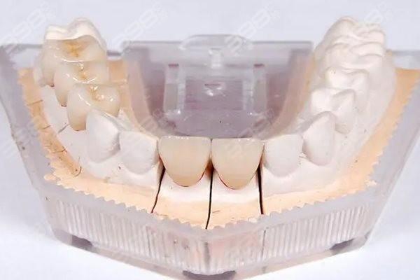 种牙与镶牙有什么区别哪个好一些,更想知道装牙装什么牙最划算