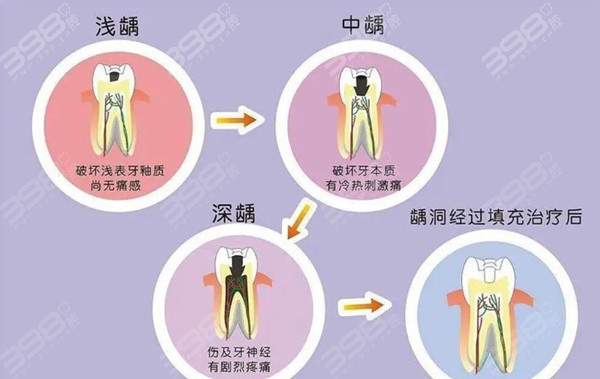 龋病的不同阶段