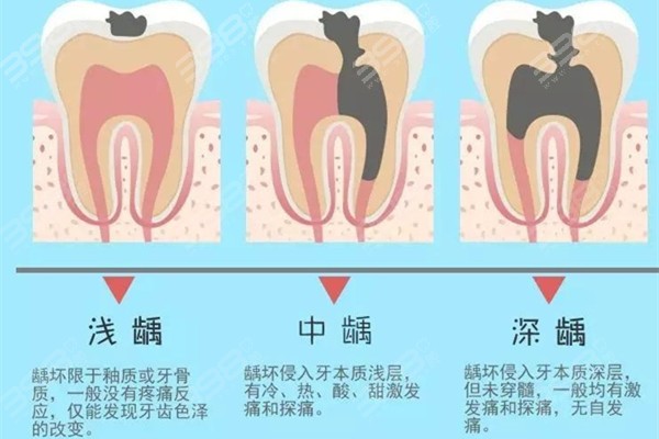 牙齿龋坏程度