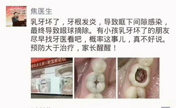 乳牙龋坏却不得不摘除眼球,这不是奇葩新闻,而是口腔健康观念不够!