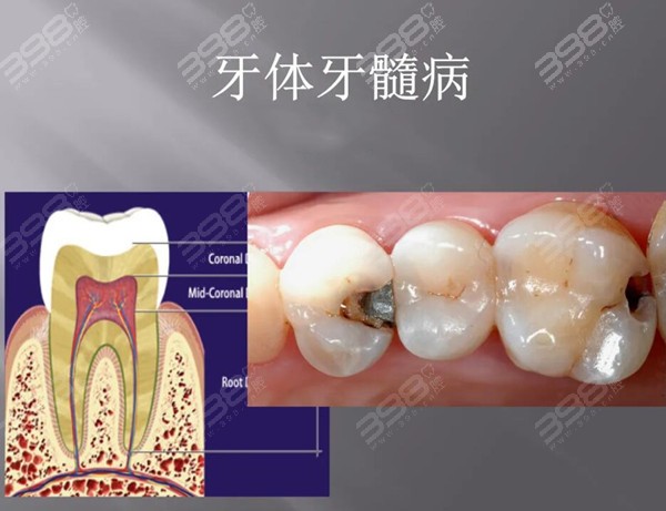 牙体、牙髓病变引起