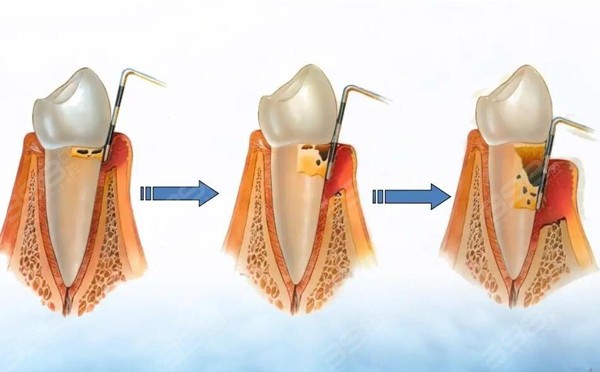 牙周病引起