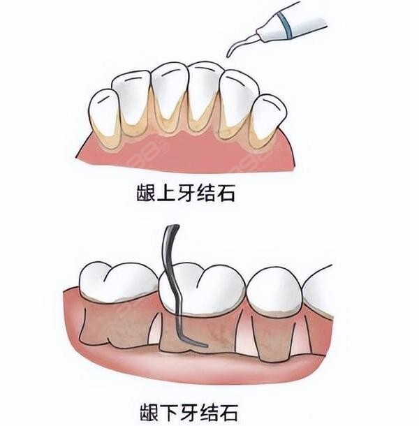 牙周刮治一颗多少钱?各地口腔医院龈下牙结石洁治费用大参考