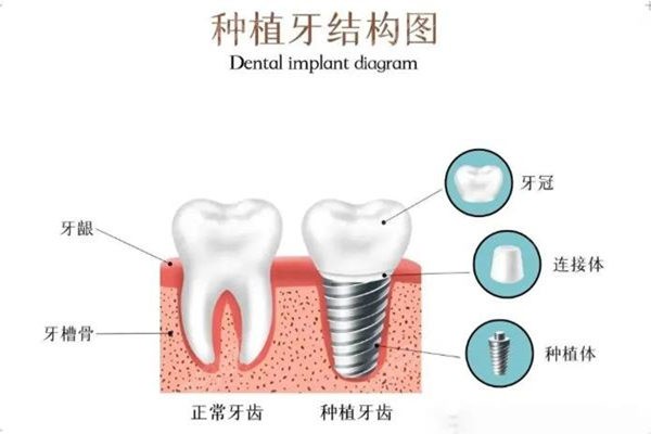 种植牙结构图