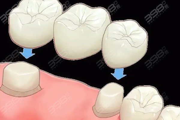 沈阳哪里镶牙经济实惠