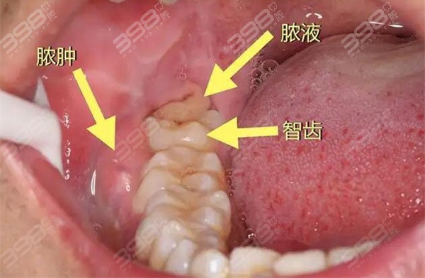 扬州菲特口腔拔智齿