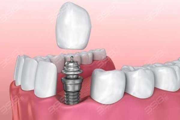 扬州菲特口腔种植牙多少钱