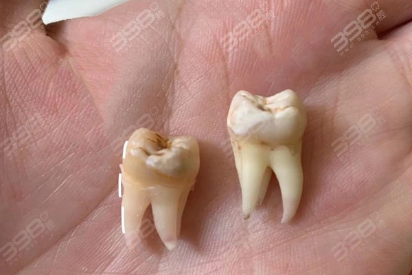 什么叫智齿牙图片