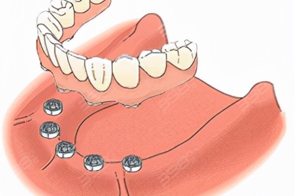半口半固定种植牙图片