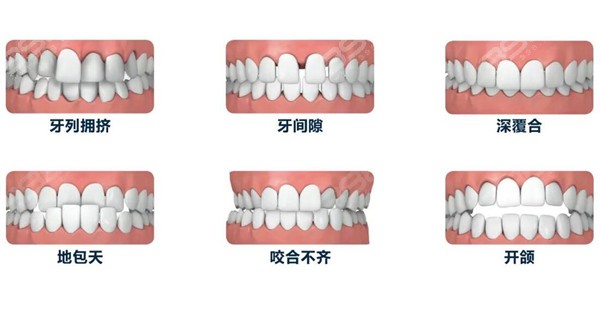 戴牙套需要注意哪些问题和饮食注意事项?这几点一定要做到!