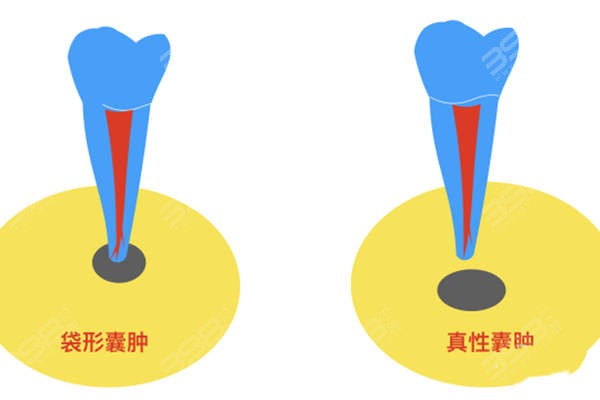 根尖囊肿种类