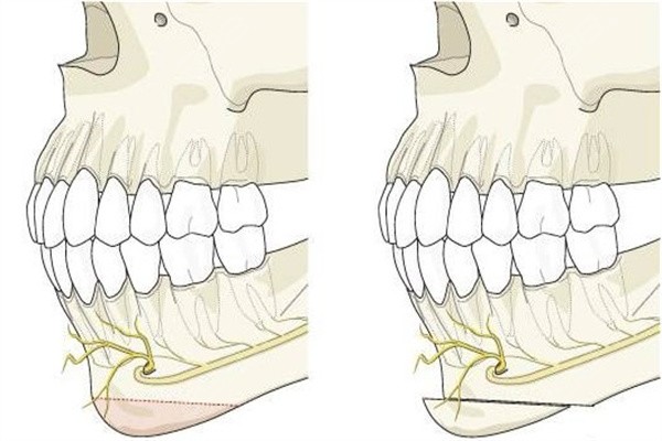 正颌手术