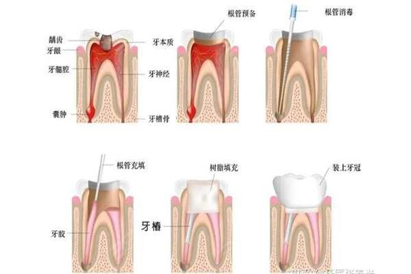 根管治疗