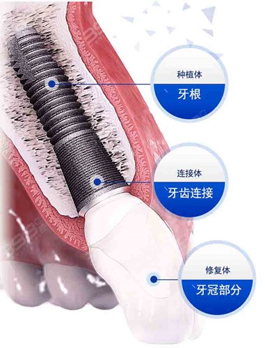 广州德伦口腔种植牙优惠价格表