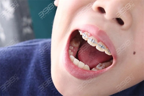 牙齿不整齐会遗传吗？原来牙列不齐也有可能遗传给孩子