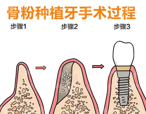 拔牙后不种牙牙龈萎缩的危害有多大？
