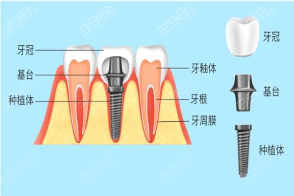 种植牙