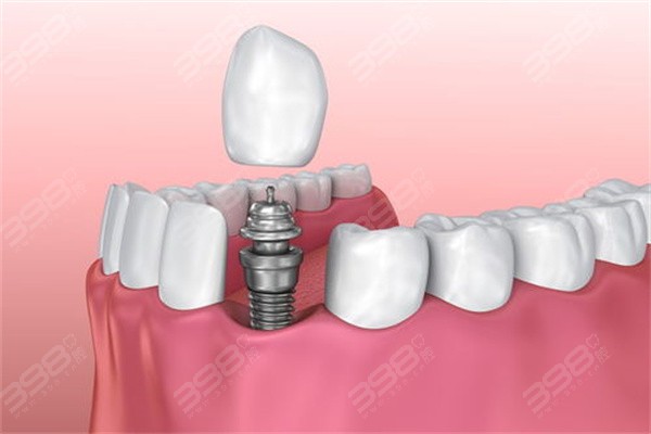 大连齿医生口腔种植牙优惠