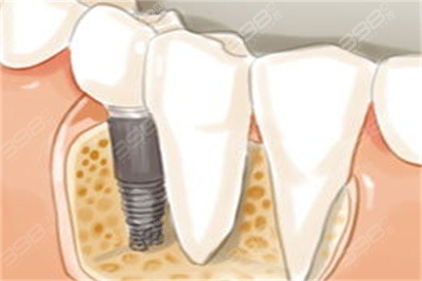 种植牙方案不合适