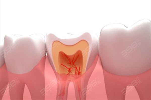 如皋牙科医院根管治疗多少钱