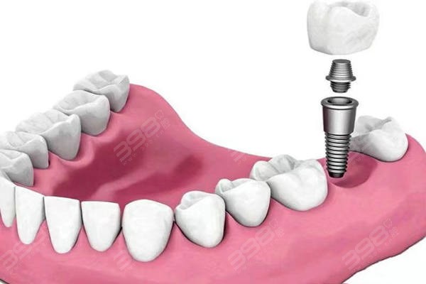 重庆口腔医院种植牙好的医院