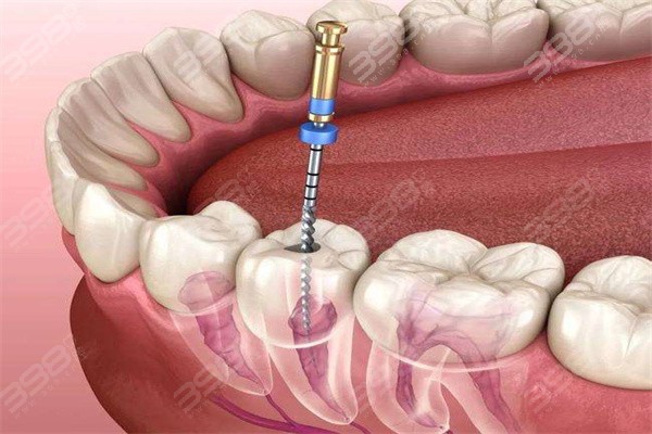 恩施根管治疗多少钱一颗牙？收费标准及看牙好的牙科一并分享