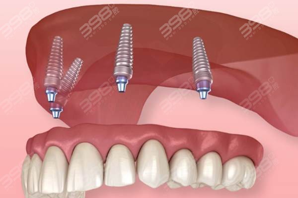 合肥瑶海区口腔医院价格满口种植牙多少钱？