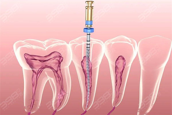 三明根管治疗多少钱