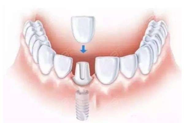 黄石牙科医院种植牙价格