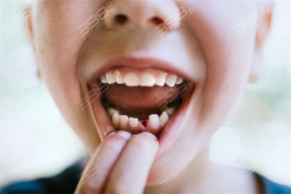 小孩子牙磕掉了补牙多少钱？修复方式不同，治疗费用也大有差异