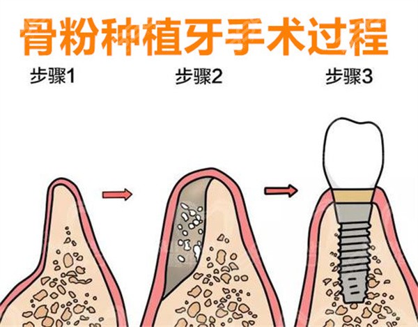 种植牙手术过程