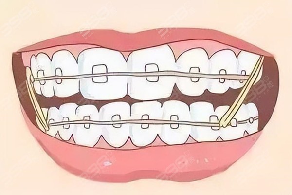 终于怀化牙齿矫正医院排名来了,牙博士/雅贝康/口腔医院正畸价格5000起