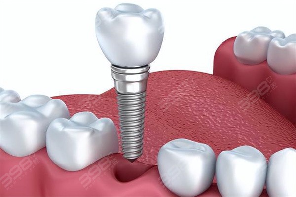 武汉种植牙多少钱一颗