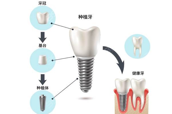 高端种植牙