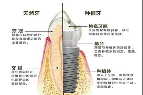 种植牙的价格分类