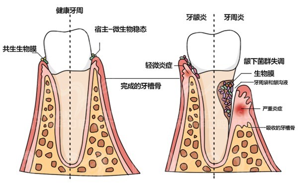 牙龈萎缩