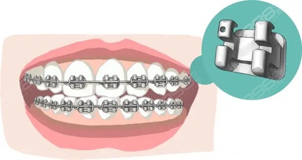 宁波金属牙齿矫正价格表