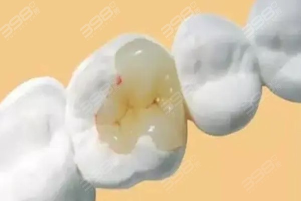 西安补牙哪里好又便宜？那就去西安补牙医保报销的医院