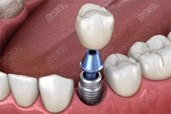 瑞士士卓曼种植牙有几种型号？ITI种植体不同型号优势、适用性对比