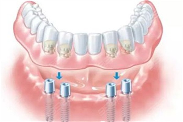 全口种植牙多少钱