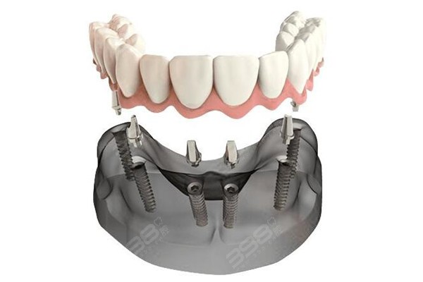 2024全口/半口种植牙多少钱——4w起