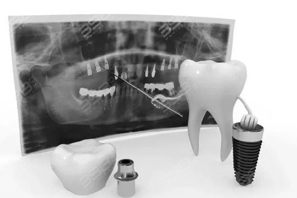 诸暨种植牙多少钱一颗？更新诸暨种牙国产/进口/半全口收费标准
