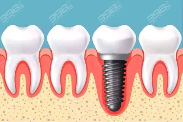 苏州种植牙费用一般是多少钱？