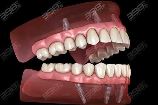 苏州全口种植牙收费标准
