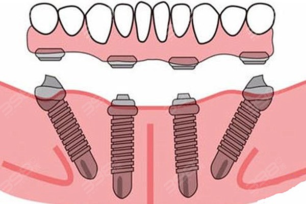 诸暨半口/全口种植牙价格表