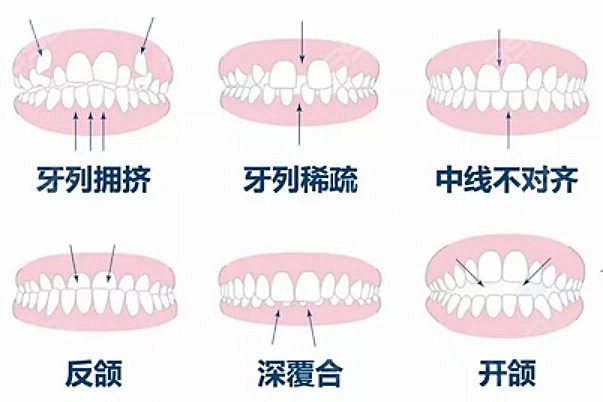 影响牙齿矫正的因素有哪些