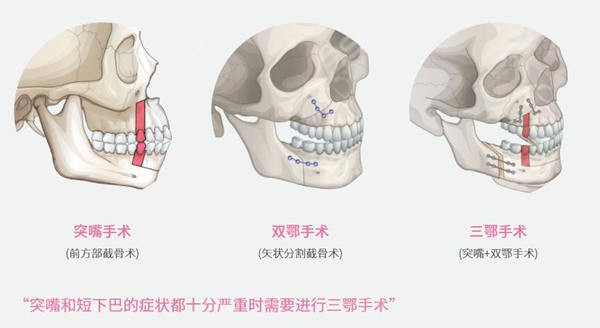 三鄂手术